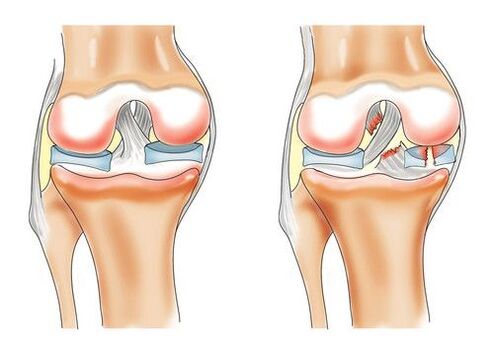 genunchi sănătos și artroza articulației genunchiului