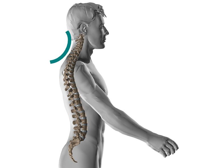 Osteocondroza cervicală a coloanei vertebrale, provocând multe simptome neplăcute