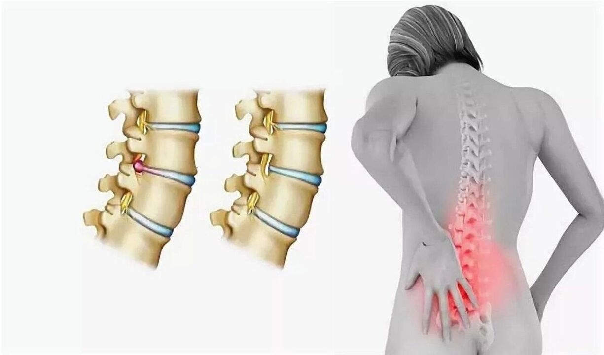 pericol de osteocondroză spinală